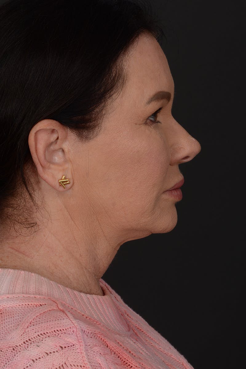Brow Lift Before & After Gallery - Patient 180622 - Image 3