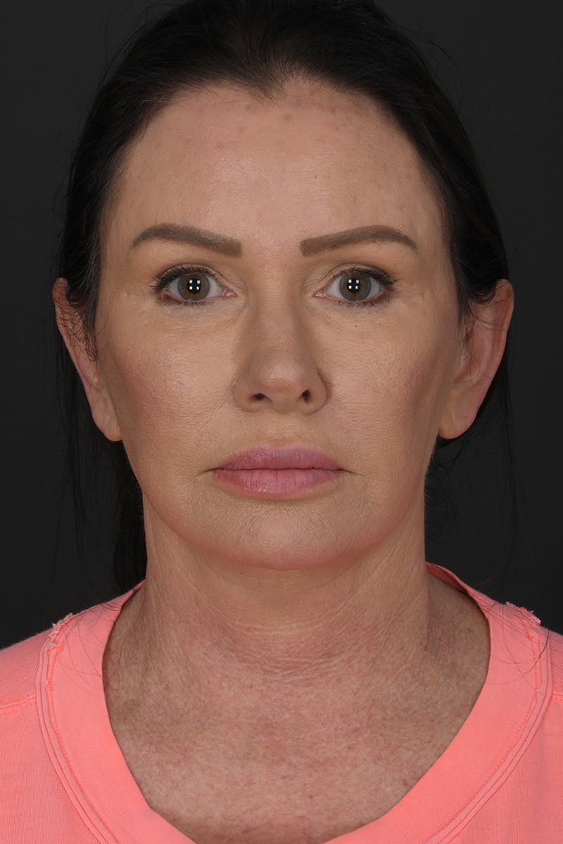 Brow Lift Before & After Gallery - Patient 180622 - Image 6