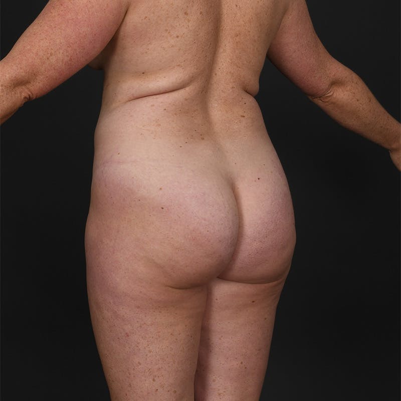 Liposuction Before & After Gallery - Patient 595523 - Image 5