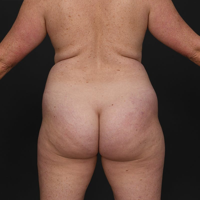 Liposuction Before & After Gallery - Patient 595523 - Image 7