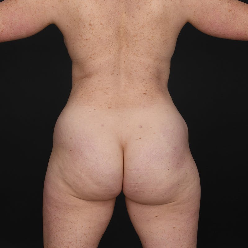 Liposuction Before & After Gallery - Patient 595523 - Image 8
