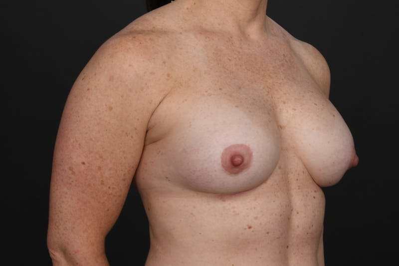 Revision Breast Augmentation Before & After Gallery - Patient 215659 - Image 4