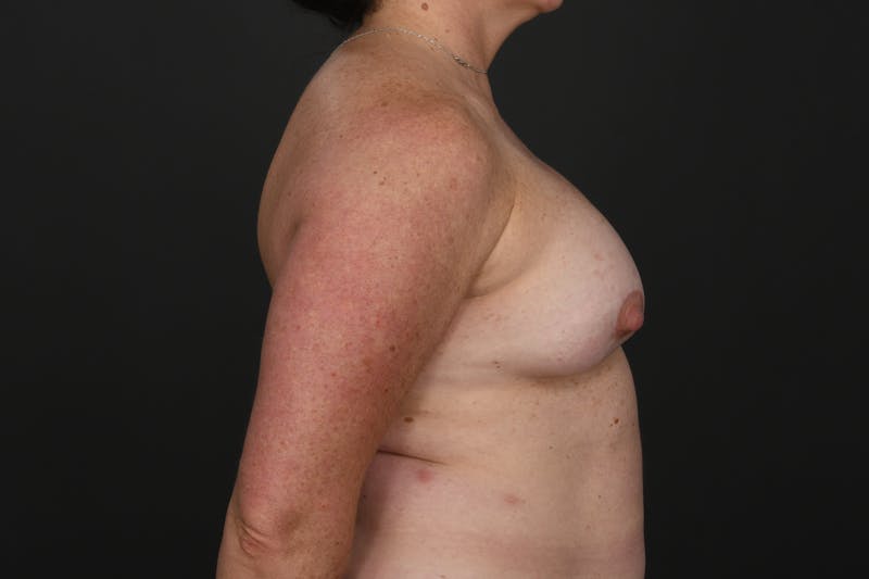 Revision Breast Augmentation Before & After Gallery - Patient 215659 - Image 5