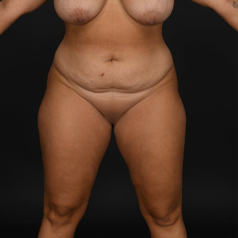 Tummy Tuck Before & After Gallery - Patient 926432 - Image 1