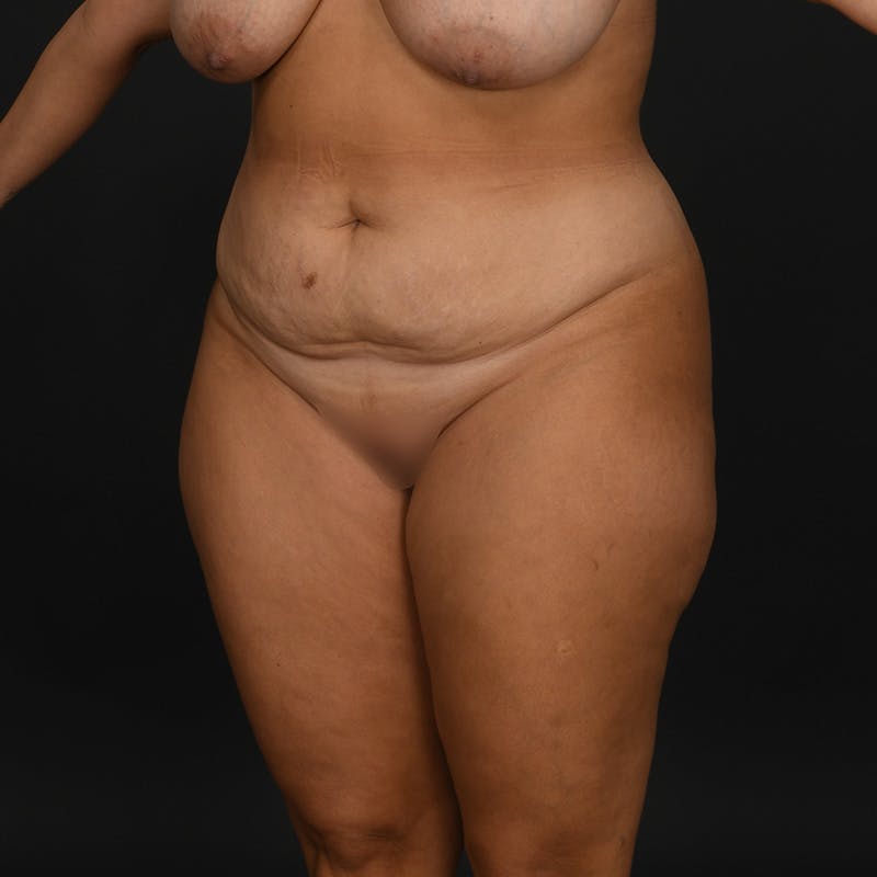 Tummy Tuck Before & After Gallery - Patient 926432 - Image 3