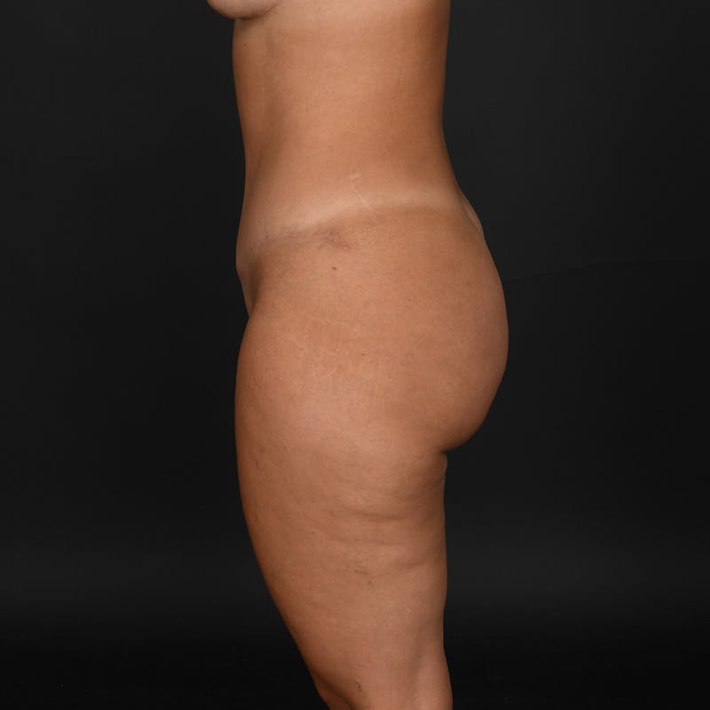 Tummy Tuck Before & After Gallery - Patient 926432 - Image 6