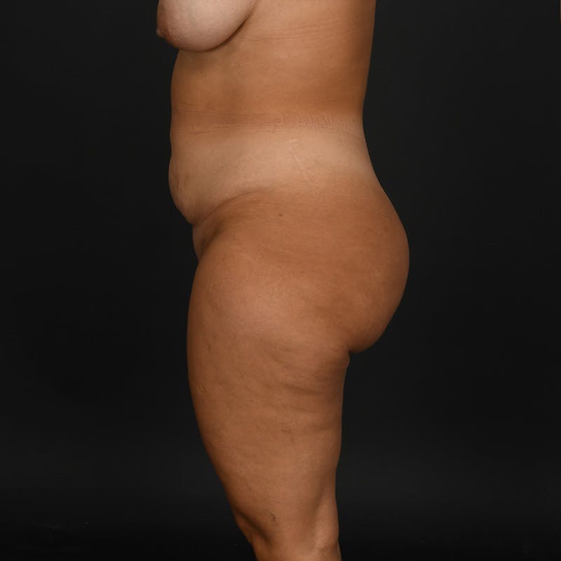 Tummy Tuck Before & After Gallery - Patient 926432 - Image 5