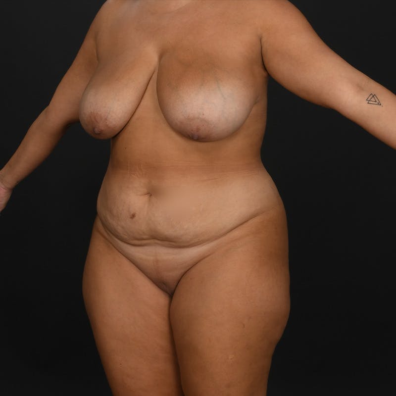 Mommy Makeover Before & After Gallery - Patient 101338 - Image 3