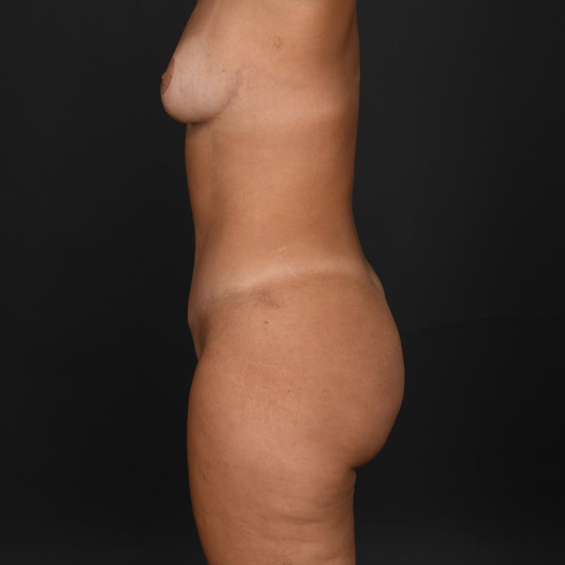 Mommy Makeover Before & After Gallery - Patient 101338 - Image 6