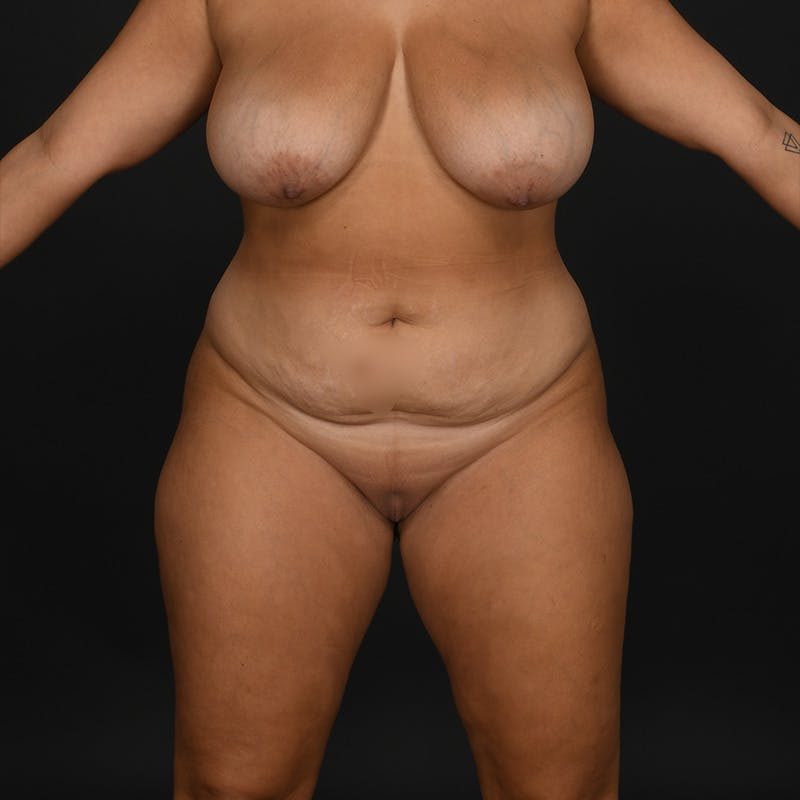 Mommy Makeover Before & After Gallery - Patient 101338 - Image 1