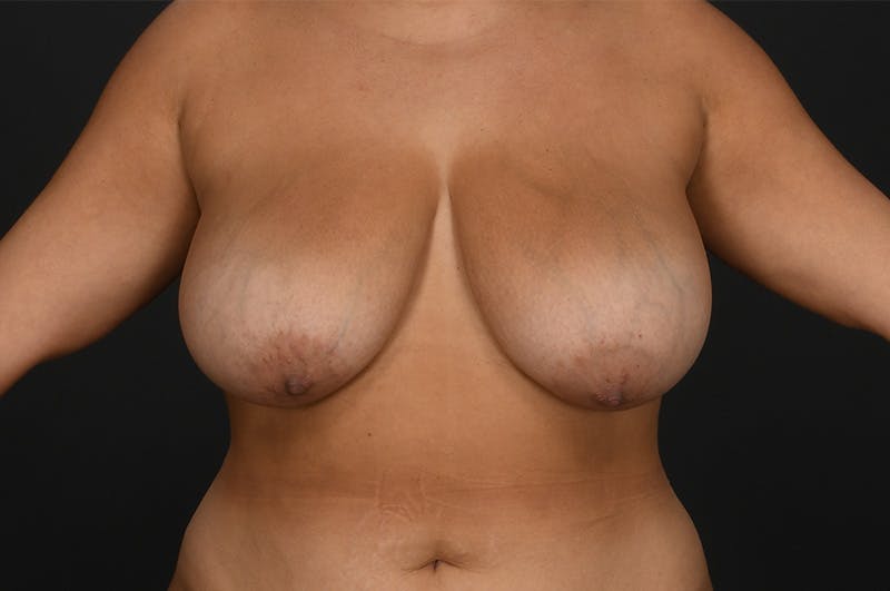 Breast Reduction Before & After Gallery - Patient 188330 - Image 1