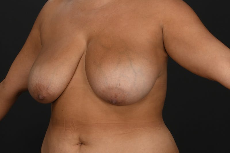 Breast Reduction Before & After Gallery - Patient 188330 - Image 3