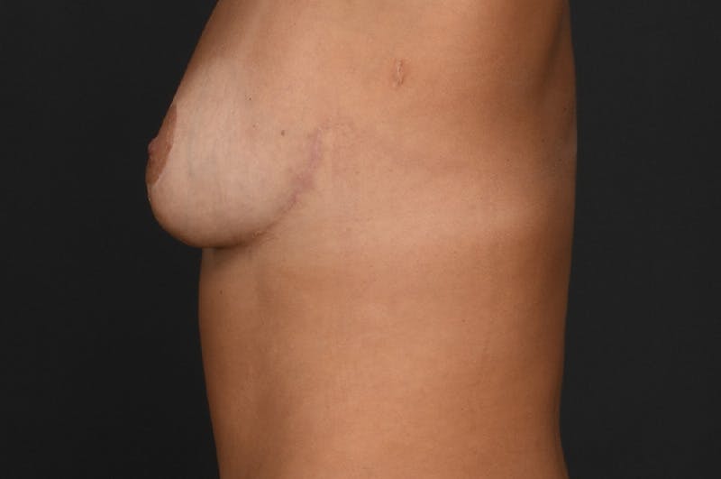 Breast Reduction Before & After Gallery - Patient 188330 - Image 6