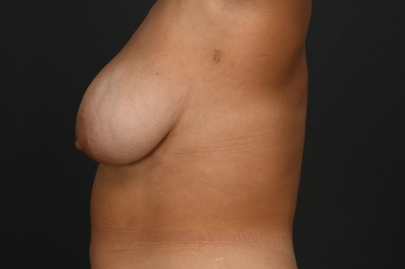 Breast Reduction Before & After Gallery - Patient 188330 - Image 5