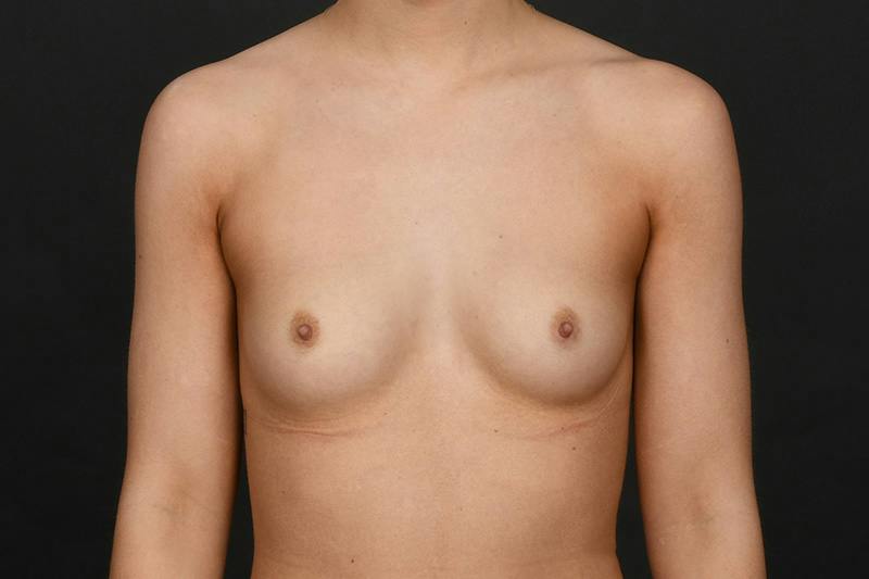 Breast Augmentation Before & After Gallery - Patient 104937 - Image 1