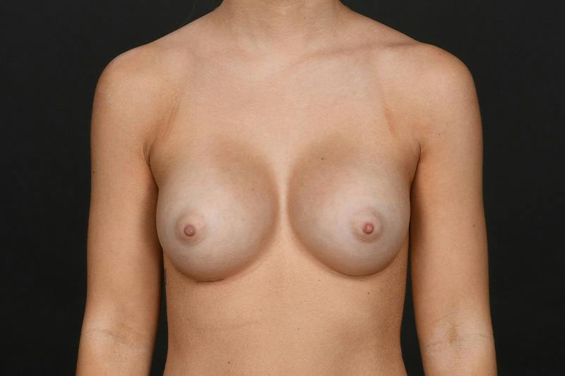 Breast Augmentation Before & After Gallery - Patient 104937 - Image 2