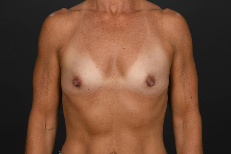 Breast Augmentation Before & After Gallery - Patient 381158 - Image 1