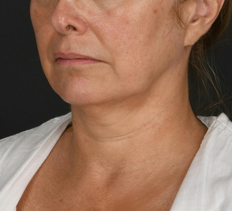 Neck Lift Before & After Gallery - Patient 103868 - Image 3