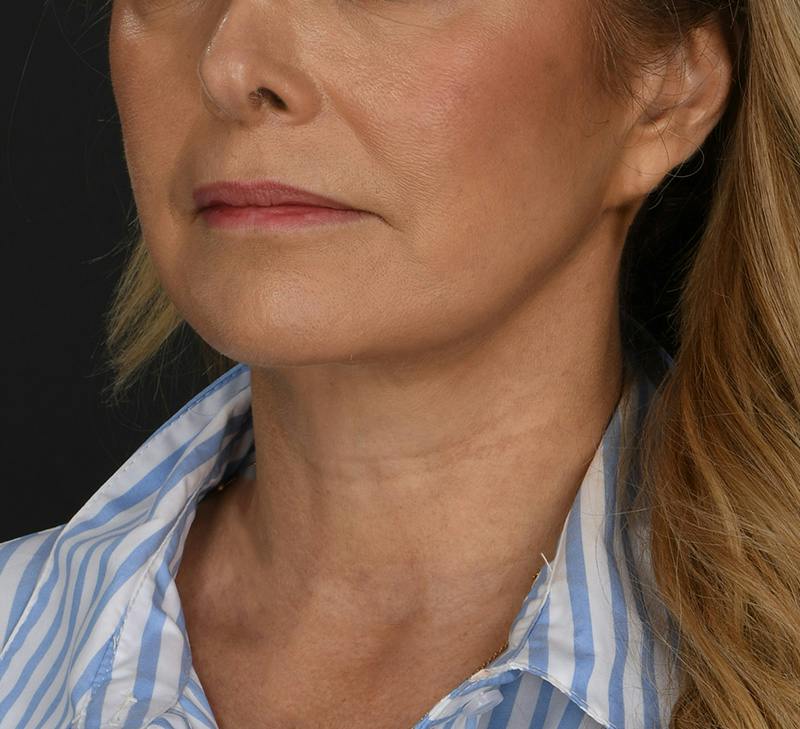 Neck Lift Before & After Gallery - Patient 103868 - Image 4