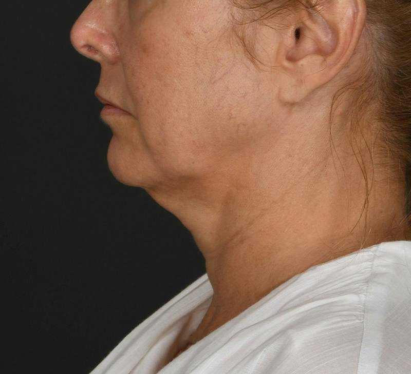 Neck Lift Before & After Gallery - Patient 103868 - Image 1