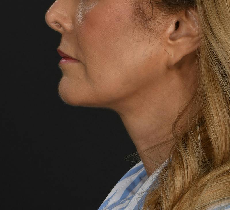 Neck Lift Before & After Gallery - Patient 103868 - Image 2