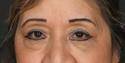 Blepharoplasty Before & After Gallery - Patient 450084 - Image 1