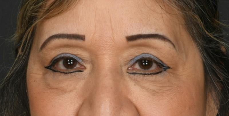 Blepharoplasty Before & After Gallery - Patient 450084 - Image 1