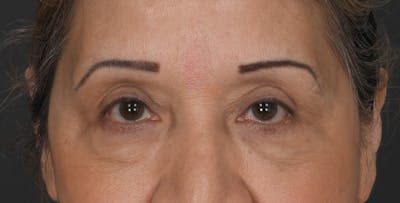 Blepharoplasty Before & After Gallery - Patient 450084 - Image 2