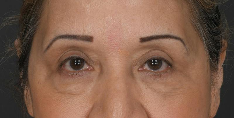 Blepharoplasty Before & After Gallery - Patient 450084 - Image 2