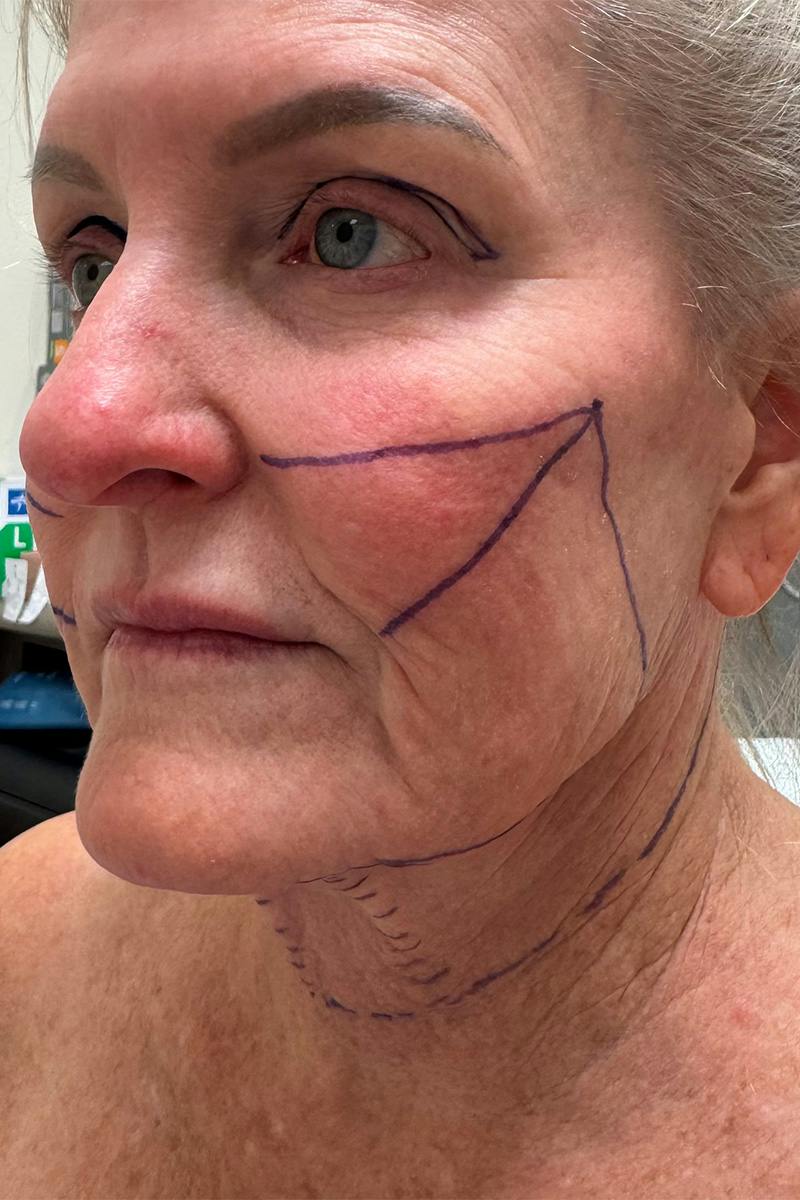 Composite Facelift Before & After Gallery - Patient 662881 - Image 1