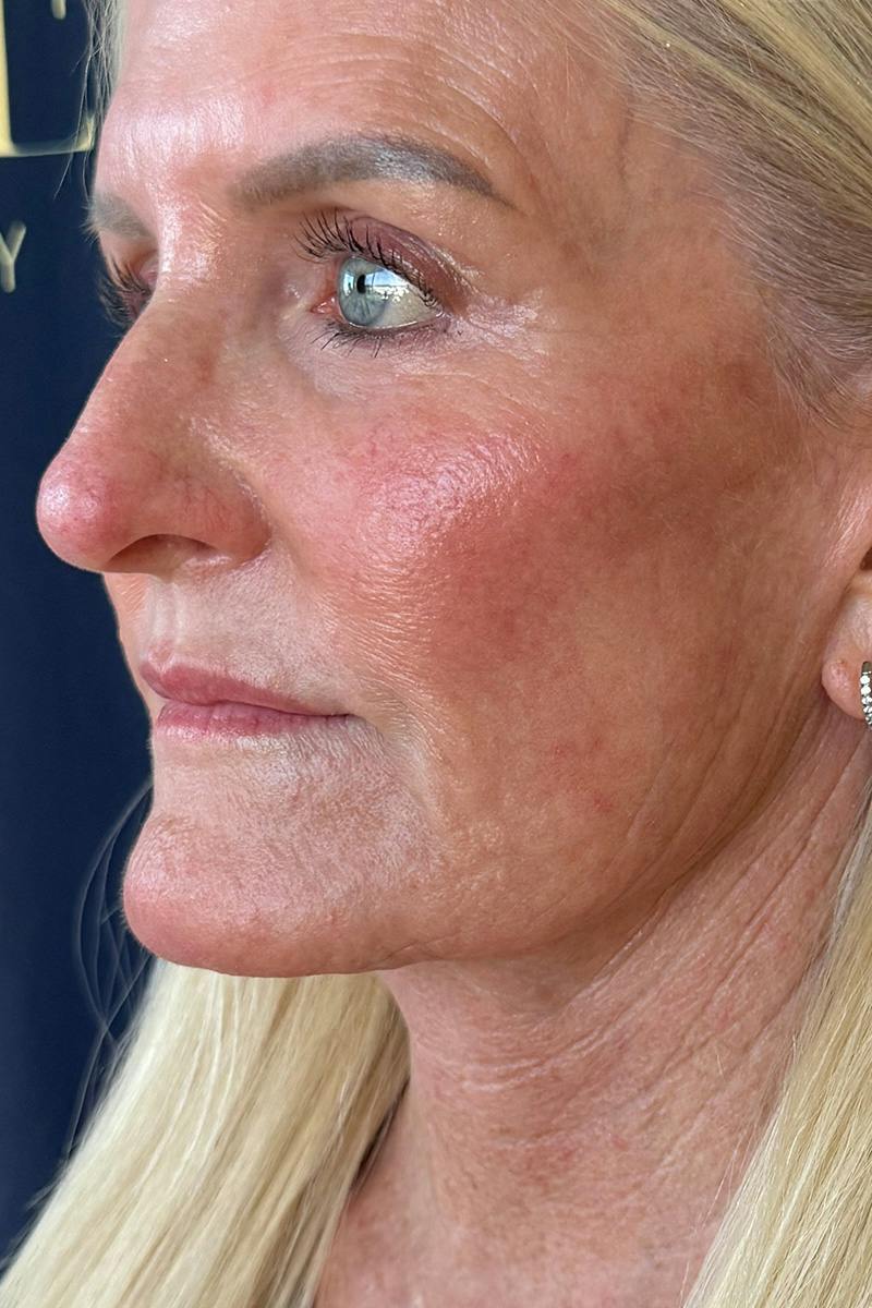 Composite Facelift Before & After Gallery - Patient 662881 - Image 2