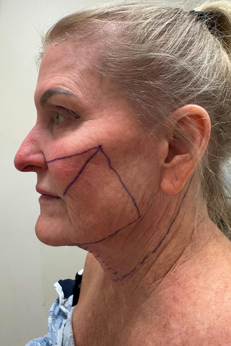 Composite Facelift Before & After Gallery - Patient 662881 - Image 3
