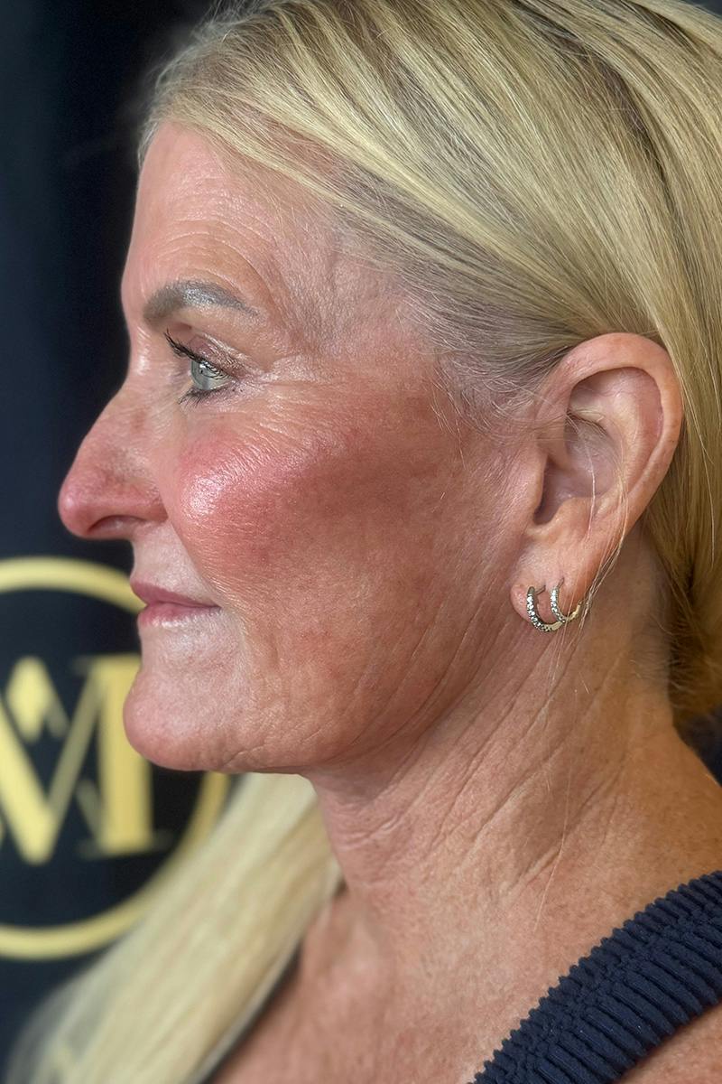 Composite Facelift Before & After Gallery - Patient 662881 - Image 4