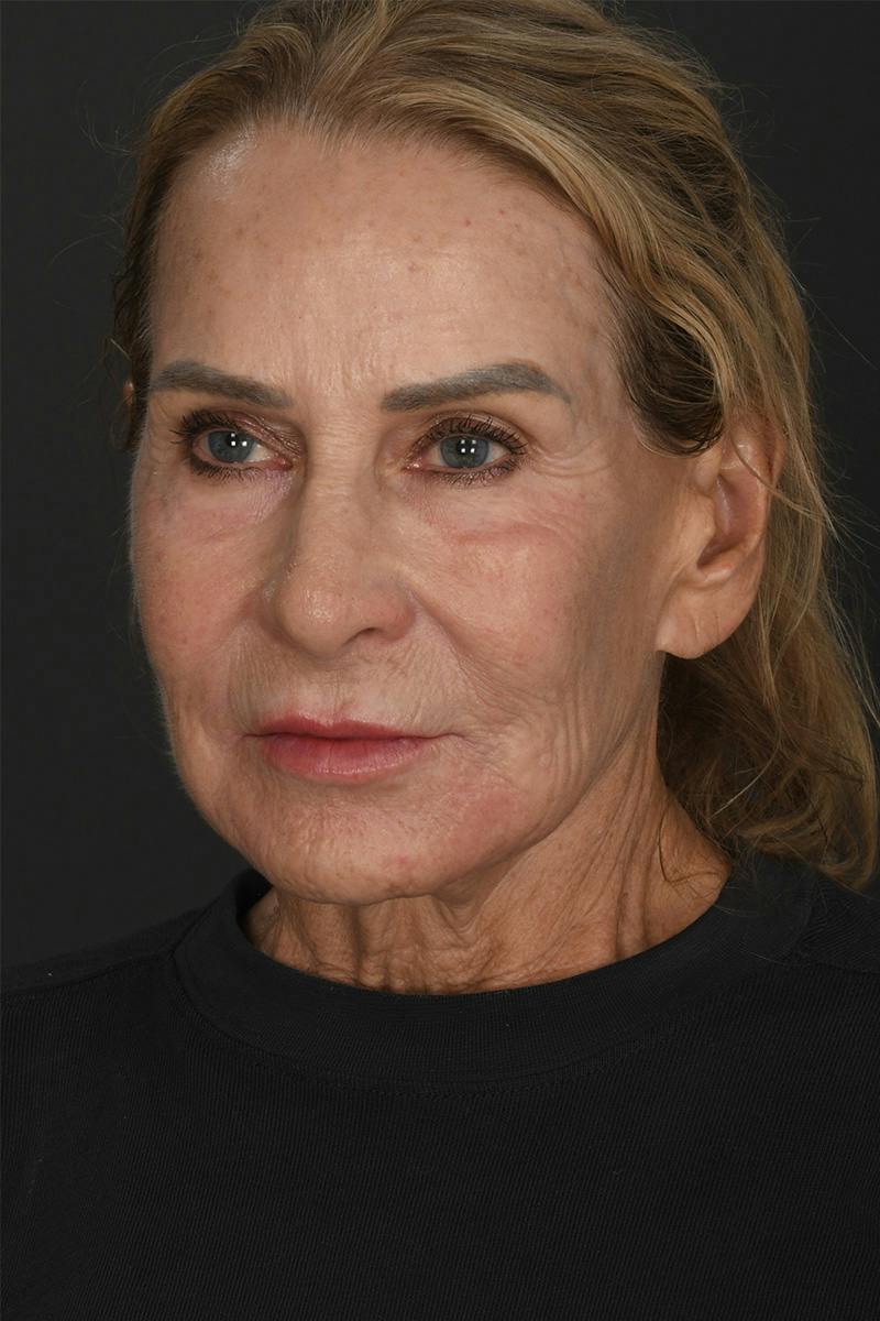 Brow Lift Before & After Gallery - Patient 124427 - Image 1
