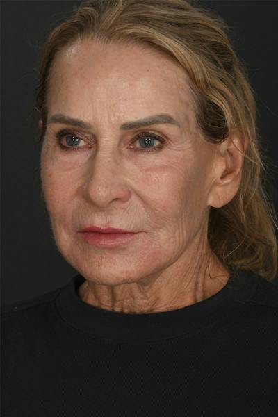 Composite Facelift Before & After Gallery - Patient 115761 - Image 1