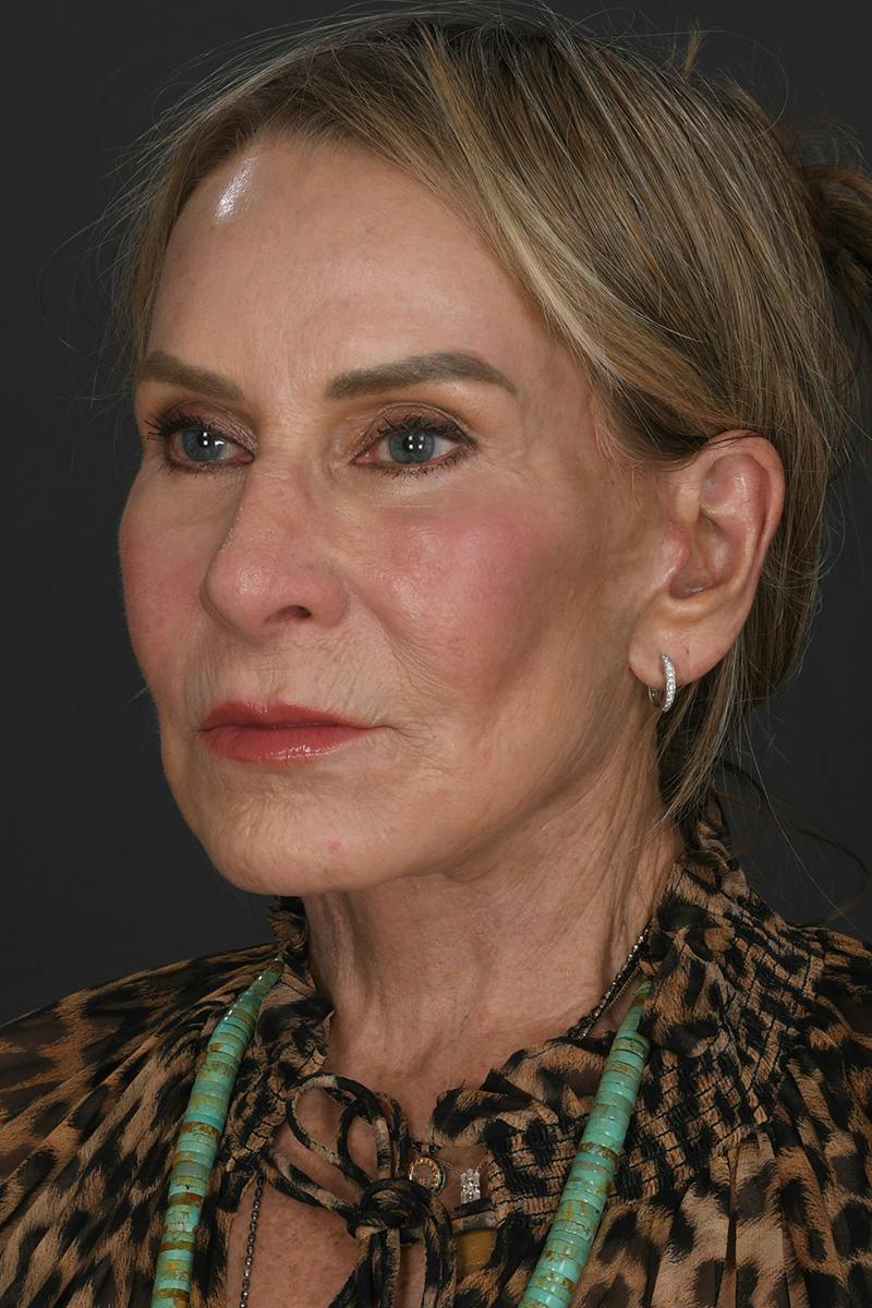 Brow Lift Before & After Gallery - Patient 124427 - Image 2
