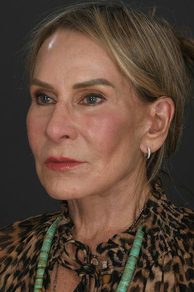 Composite Facelift Before & After Gallery - Patient 115761 - Image 2