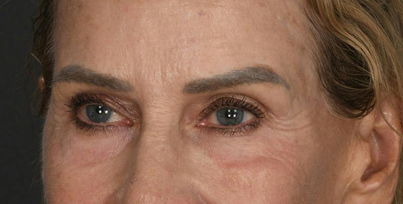 Blepharoplasty Before & After Gallery - Patient 383162 - Image 1