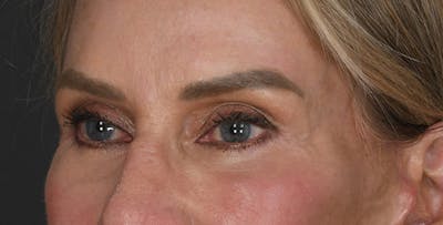 Blepharoplasty Before & After Gallery - Patient 383162 - Image 2