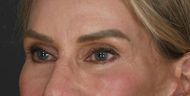 Blepharoplasty Before & After Gallery - Patient 383162 - Image 2