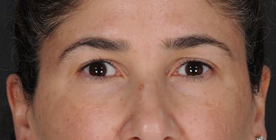 Blepharoplasty Before & After Gallery - Patient 521169 - Image 1