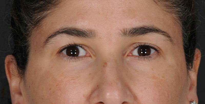 Blepharoplasty Before & After Gallery - Patient 521169 - Image 1