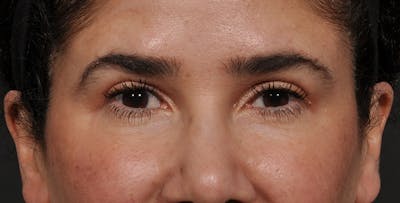 Blepharoplasty Before & After Gallery - Patient 521169 - Image 2