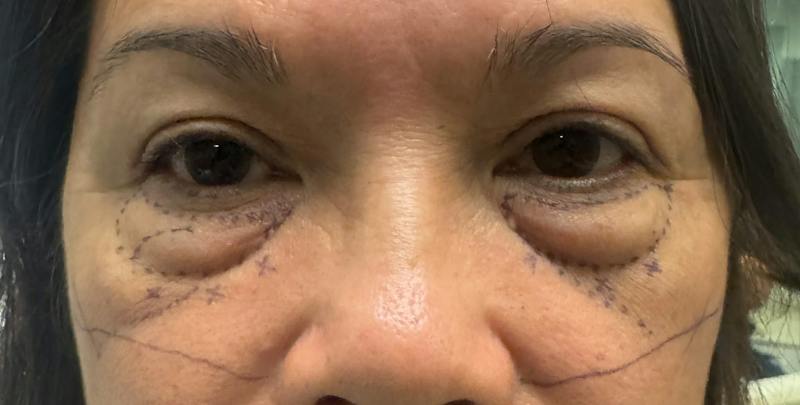 Blepharoplasty Before & After Gallery - Patient 860316 - Image 1