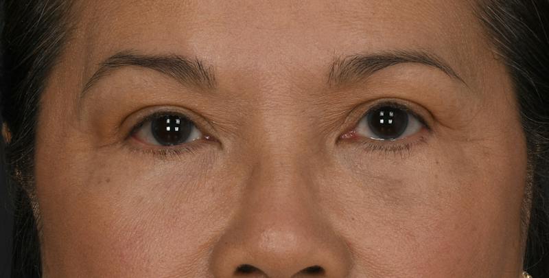 Blepharoplasty Before & After Gallery - Patient 860316 - Image 2