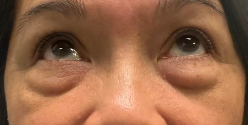 Blepharoplasty Before & After Gallery - Patient 860316 - Image 3