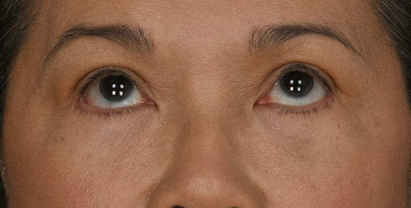 Blepharoplasty Before & After Gallery - Patient 860316 - Image 4
