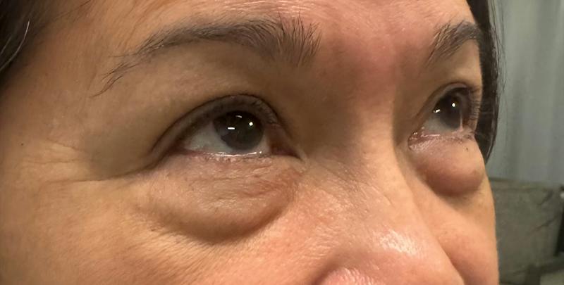 Blepharoplasty Before & After Gallery - Patient 860316 - Image 5