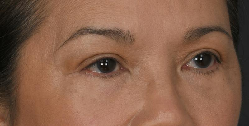 Blepharoplasty Before & After Gallery - Patient 860316 - Image 6