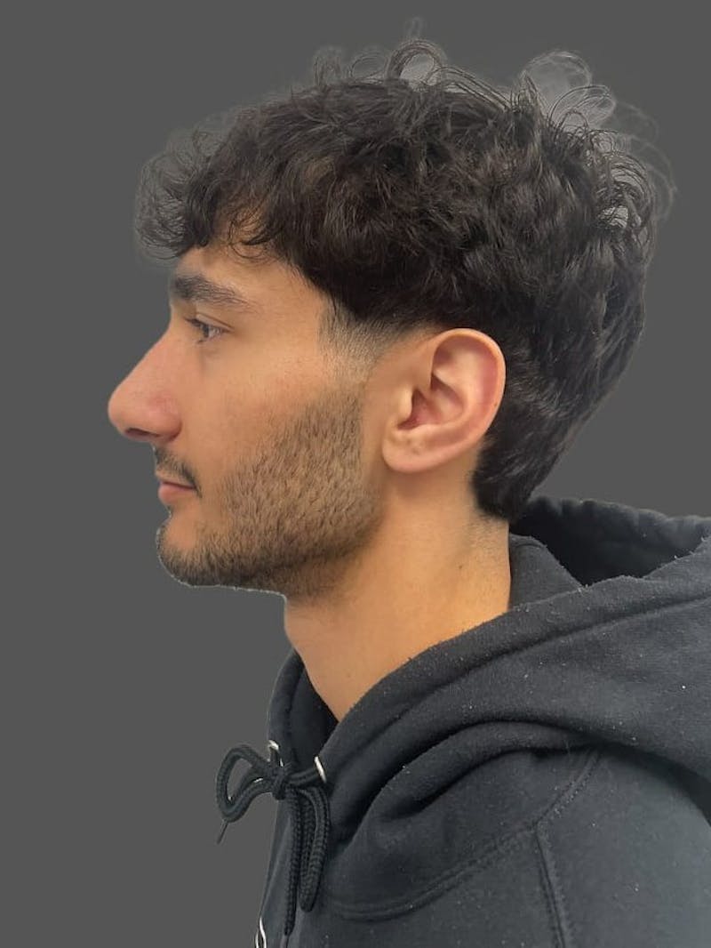 Rhinoplasty Before & After Gallery - Patient 103960 - Image 2